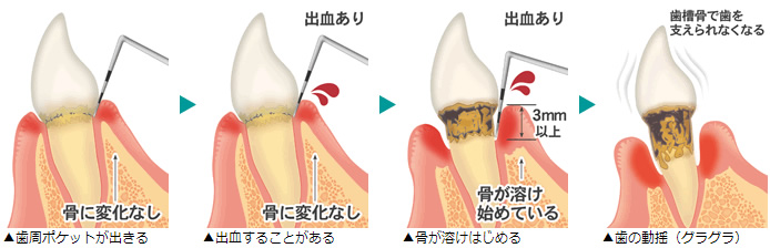 歯周病進行の様子