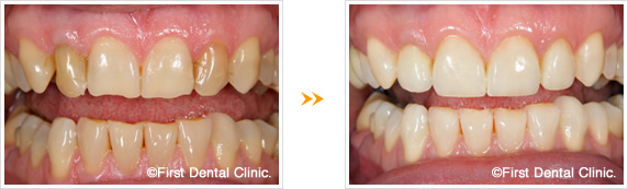 セラミック審美歯科治療の症例
