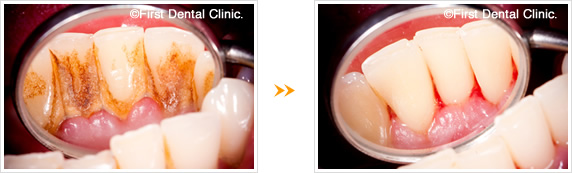 歯石除去の例