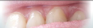 歯ぐきの移植治療
